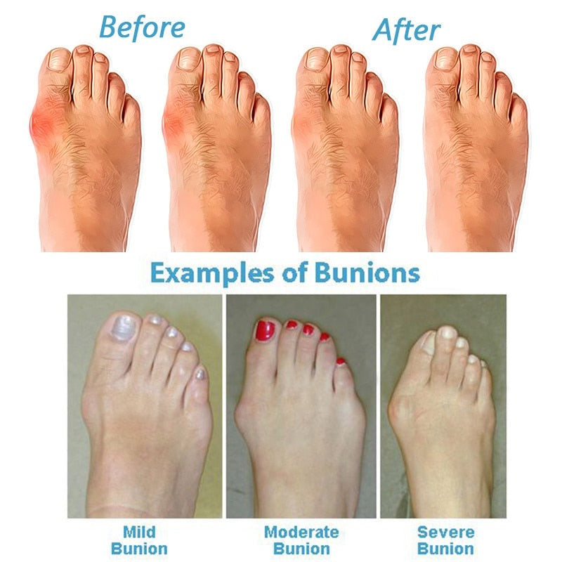 HexoBunion™ Orthopedische & Corrigerende Sandalen voor Bunions