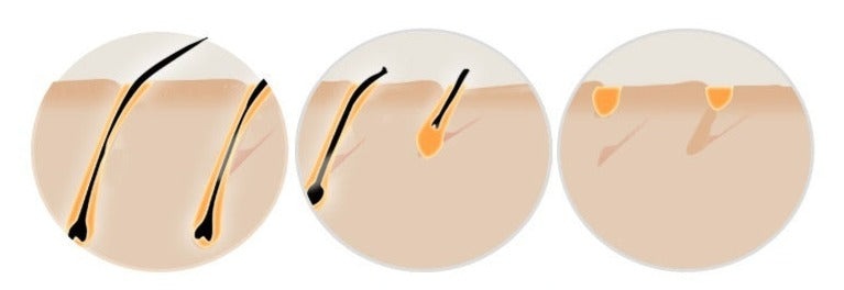 HexoSkin™ IPL-Laserontharingsapparaat voor Thuis