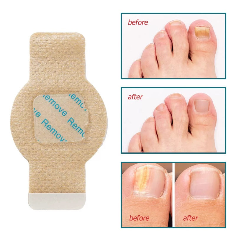 HexoNail™ Hydrogel nagelpleisters voor verkleurde en beschadigde nagels – 21 stuks