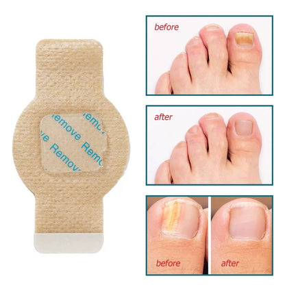 HexoNail™ Hydrogel nagelpleisters voor verkleurde en beschadigde nagels – 21 stuks