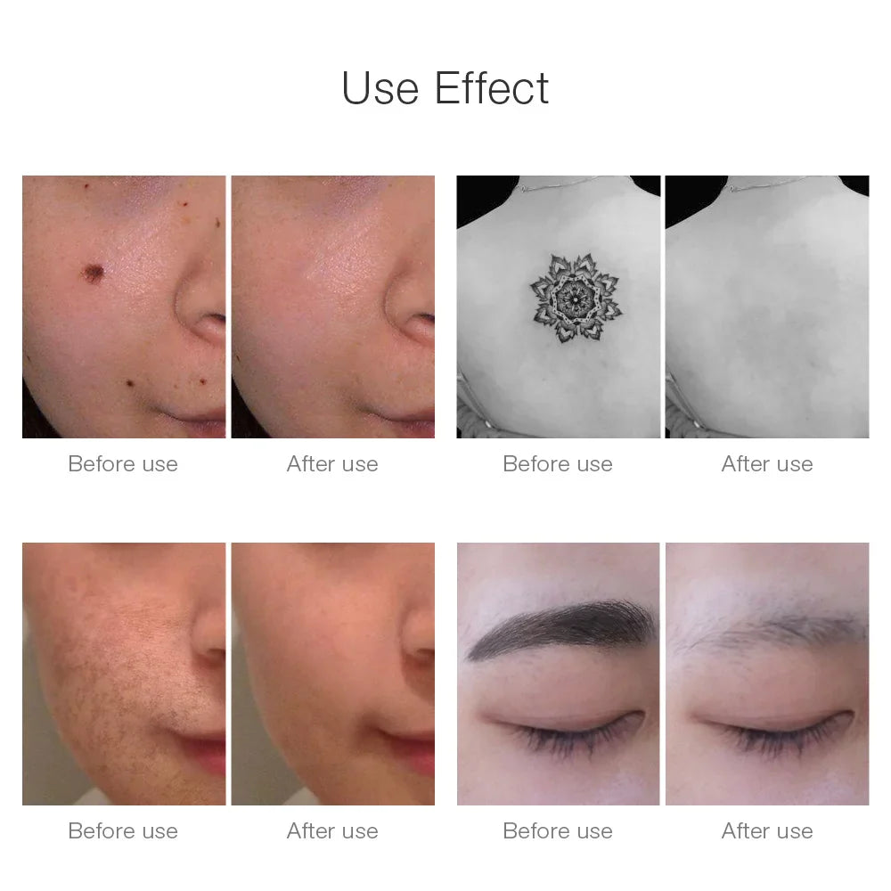 Neatcell™ – Picoseconde Laser Verwijderaar voor Tatoeages & Vlekken